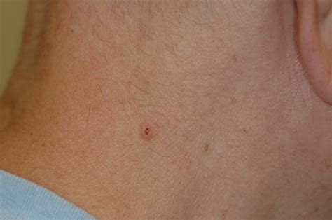 Disease Management: Nonmelanoma Skin Cancer