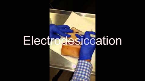 Electrodesiccation and Curettage (ED&C) - How To - YouTube