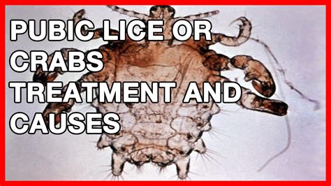 How to Get Rid of Pubic Lice or Crabs - YouTube