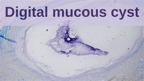 Digital Mucous Cyst - Pathology mini tutorial - YouTube