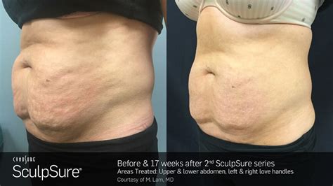 Laser Body Contouring - Before and After | SculpSure