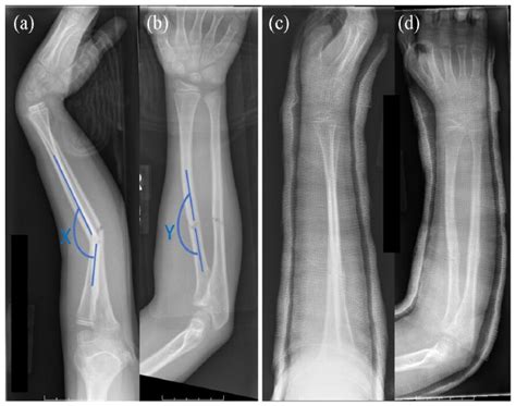 Predictors for operative treatment in pediatric proximal third both-bone diaphyseal forearm ...