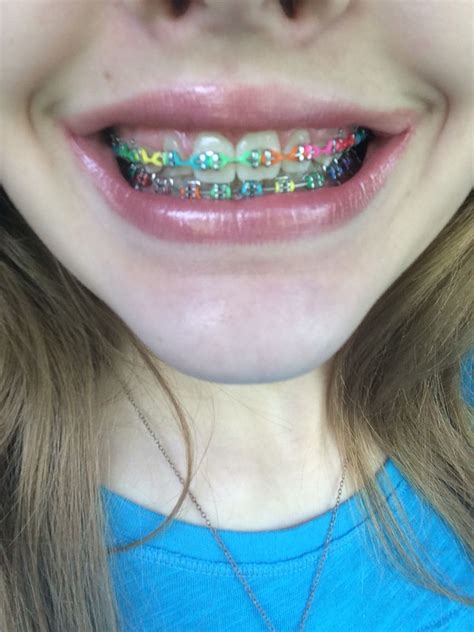 Technicolor braces. Aren't they cool? It's like having a rainbow mouth ...