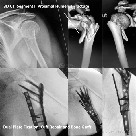 Proximal Humerus | Medical Case Study | Sydney Shoulder Unit