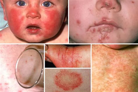 From meningitis to eczema and measles... the ultimate baby rash guide - and when you should ...