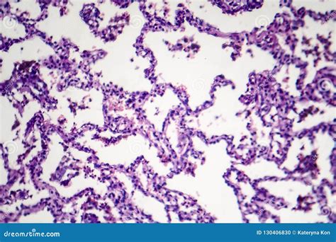 Lobar Pneumonia, Resolution Period Stock Photo - Image of histology ...