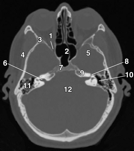 Get Anatomy Skull Base Ct PNG | 1000diagrams