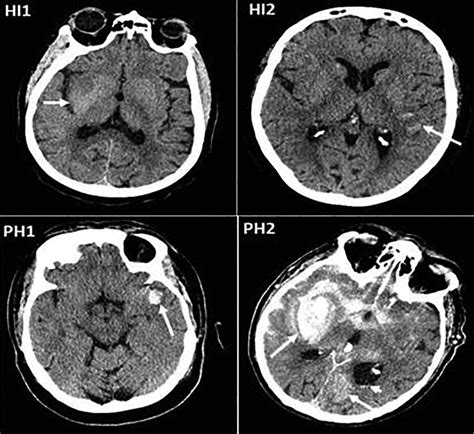 Imaging for Predicting Hemorrhagic Transformation of Acute Ischemic ...