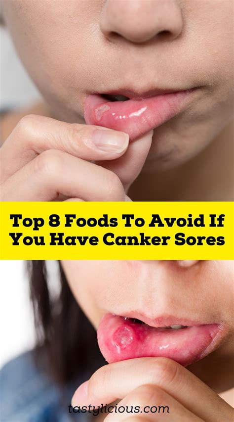 are bananas good for canker sores | is milk good for canker sores ...