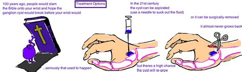 Ganglion Cyst — Bone Talks