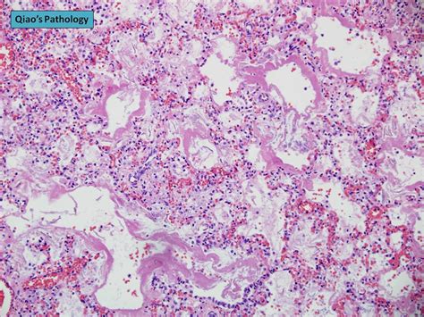 Qiao's Pathology: Hyaline Membrane Disease (Infant Respira… | Flickr