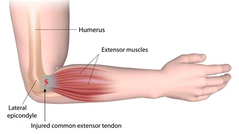 Physiotherapy for Elbow and Forearm Pain - Glebe Physio