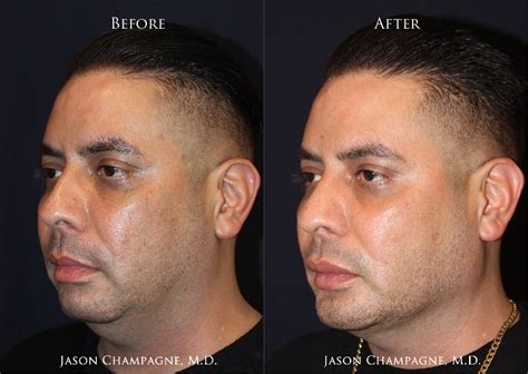 Create Strong Facial Structure with a Custom Chin and Jaw Implant ...