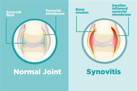 Synovial Membrane Knee