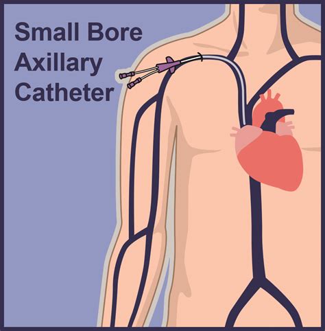 Central Venous Catheter Lines | Vascular Wellness