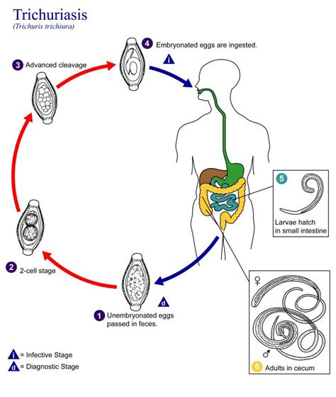 Trichuriasis - Wikipedia