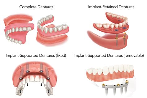 Treatment Options for the Edentulous Patient (including All-On-4 ...