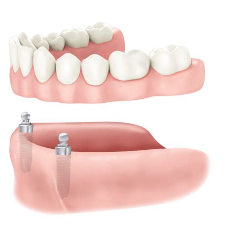 Removable Dentures on Implants in Stony Plain