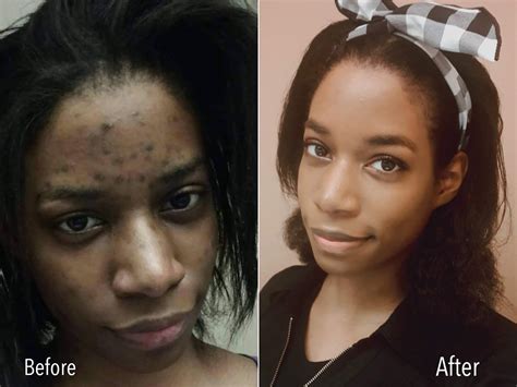 Treating Acne Scars & Hyperpigmentation on Brown Skin | Sisterlocked