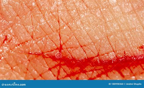 Close-up of Blood from a Wound on a Human Skin Stock Photo - Image of healthcare, wound: 188998360