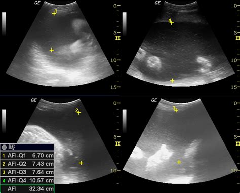 Amniotic Fluid Index Chart: How to Read the Chart and Deal With ...