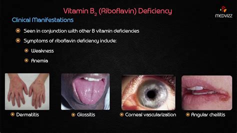 Vitamin B2 (Riboflavin) Deficiency | Vitamin B2 (Riboflavin) Deficiency ...