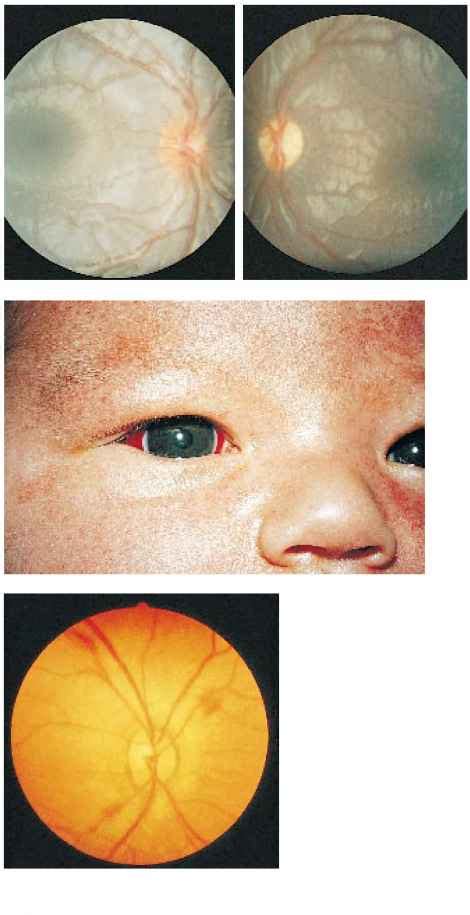 Bilateral Retinal Hemorrhage