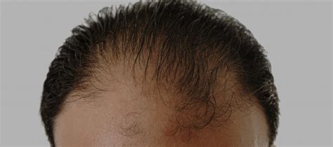 3 best hair restoration treatment options to consider - Bapna,Sumit ...