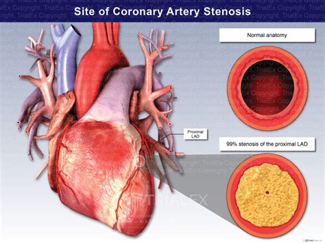 Site of Coronary Artery Stenosis - TrialExhibits Inc.