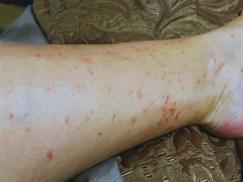 Chiggers Vs Turkey Mites: What's Biting Me in the Woods? » Kowalski ...