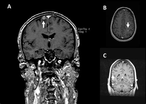 Cureus | Diagnostic Reliability of Leptomeningeal Disease Using ...