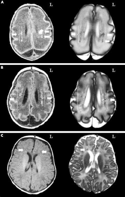 Magnetic resonance characterisation of punctate lesions. (A) Isolated... | Download Scientific ...