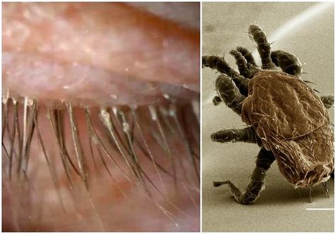 Woman who goes to hospital with itchy eyes has lash MITES - Daily Star