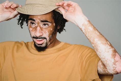 Understanding vitiligo: Causes, symptoms and treatments