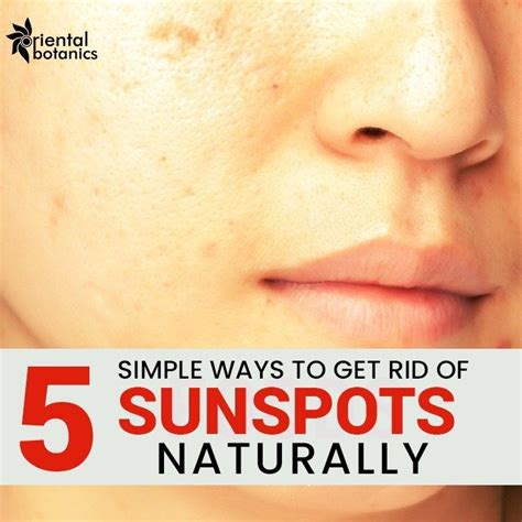 5 Simple Ways To Get Rid Of Sunspots Naturally | Sun spots on skin, Sunspots, Dark spots on skin