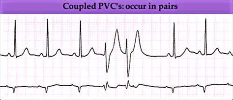 ECG: Cardiac Rhythms