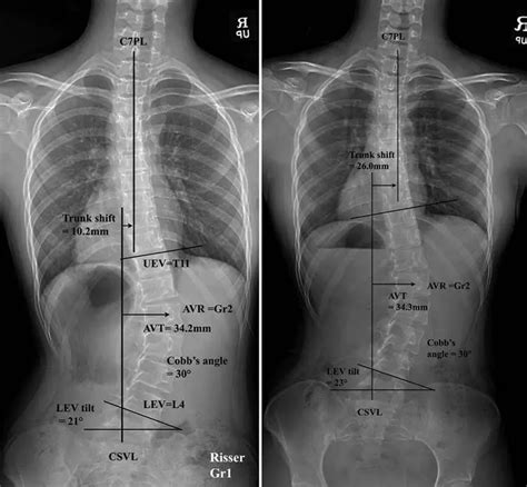 Thoracolumbar Scoliosis: Causes, Symptoms, Diagnosis, and Treatment