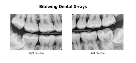 All About Dental X-Rays - Ascot Dental