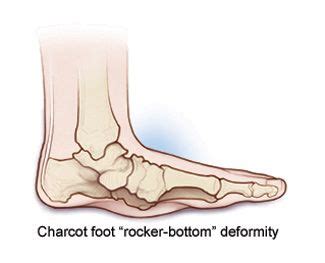 Charcot Foot | Cleveland Clinic | Feet treatment, Cleveland clinic, Foot health