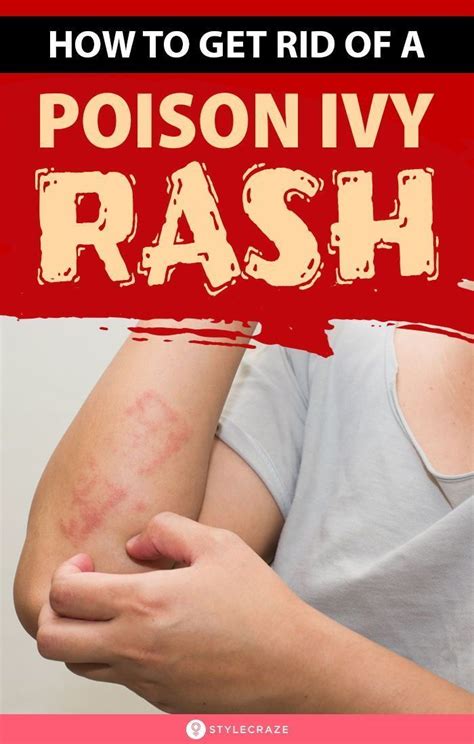 How To Get Rid Of A Poison Ivy Rash Overnight | Poison ivy rash, Poison ivy, Poison ivy remedies