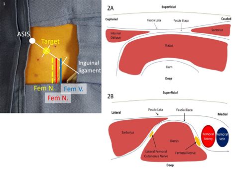 Control Hip Fracture Pain Without Opioids Using Ultrasound-Guided Fascia Iliaca Compartment ...