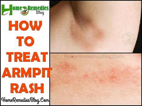 15 Home Remedies For Itchy Armpit Rash - Home Remedies Blog