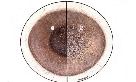 Fuchs corneal endothelial dystrophy