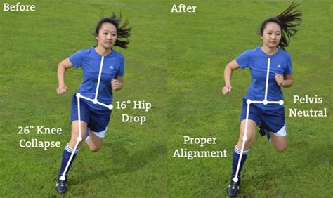 ACL Prevention Programs: Can We Do More? - Sports Medicine Review