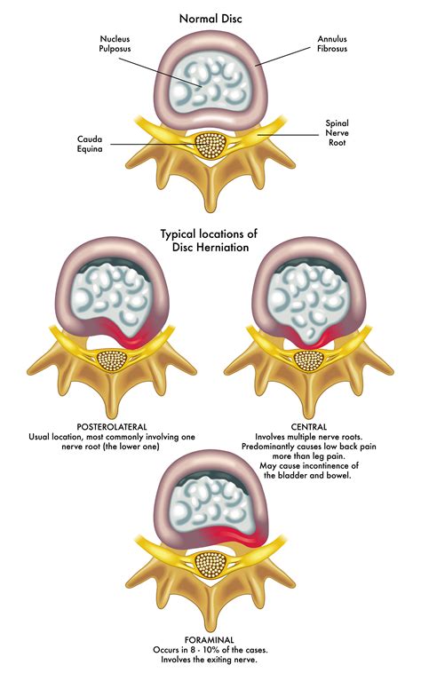 Disc Prolapse & Sciatica | Causes & Treatment | Dr. Chris Homan