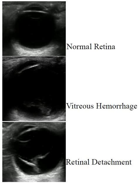 Retrospective Review of Ocular Point-of-Care Ultrasound for Detection ...