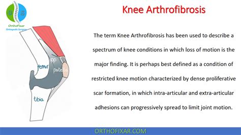 Knee Arthrofibrosis | OrthoFixar 2024