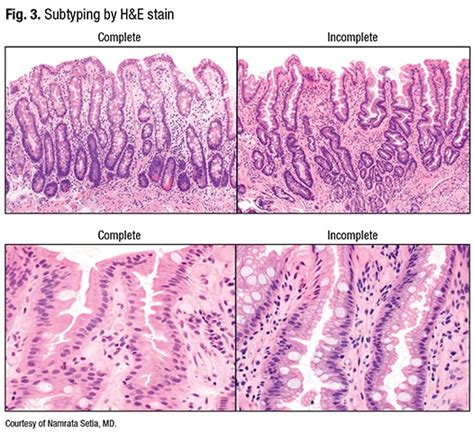 Gastric intestinal metaplasia—the need to classify and how - CAP TODAY