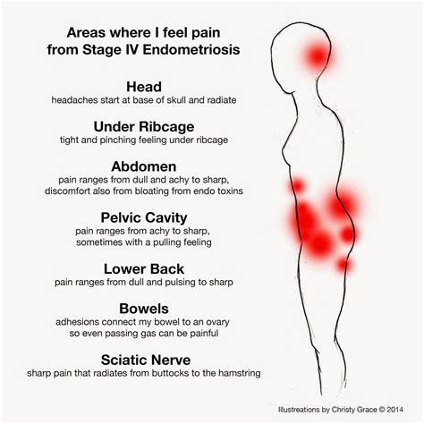 endometrial cancer symptoms back pain How is endometrial cancer diagnosed?