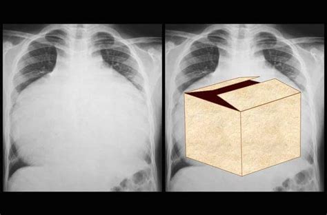 X Ray Of Heart